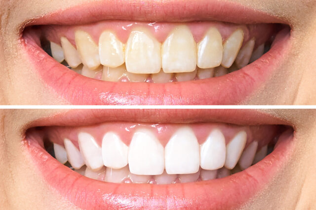 diş beyazlatma öncesi ve sonrası