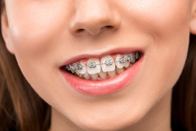beautiful young womman with teeth braces
