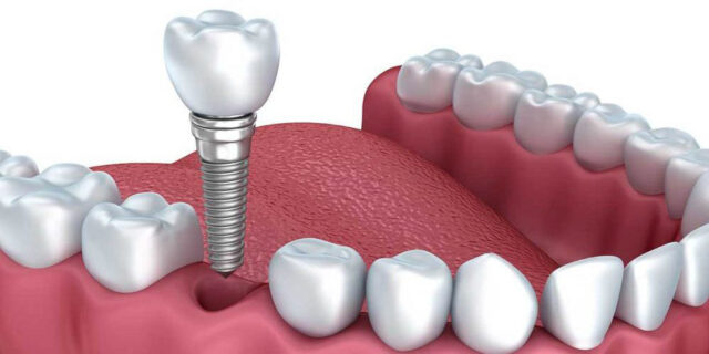 Diş kaybından sonra uygulanan implant tedavisi