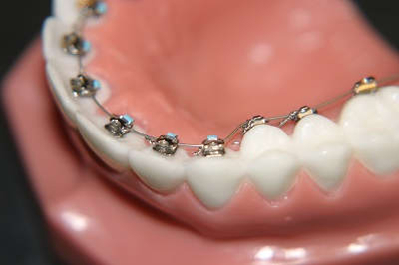 Ortodontik Bozukluklar VE Çözümleri