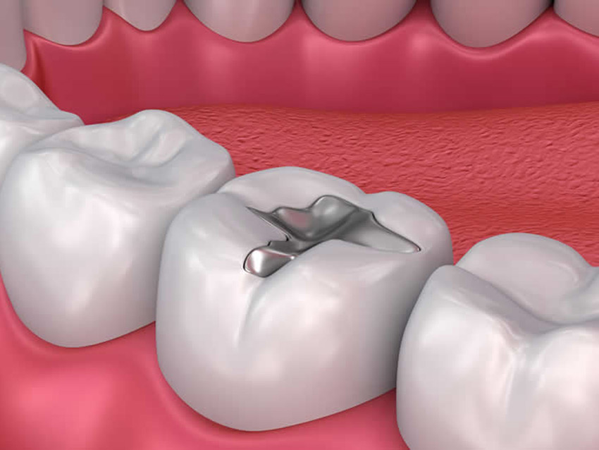 Diş Dolgusu Nedir? Konya Diş Hastanesi