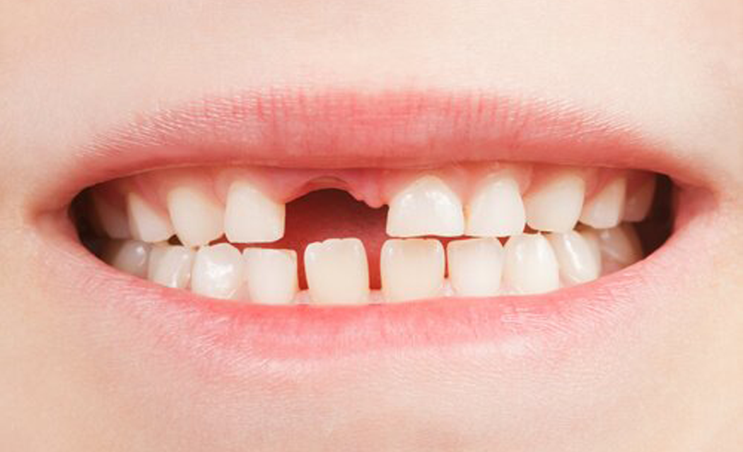 Diş Eksikliği Nasıl Oluşur ?