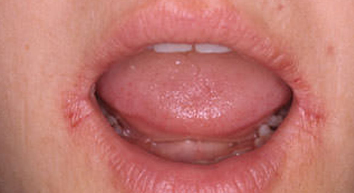 Ağız İçi Mantar Enfeksiyonları (oral thrush)