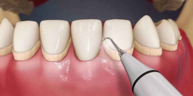 Konya diş taşı temizliği 