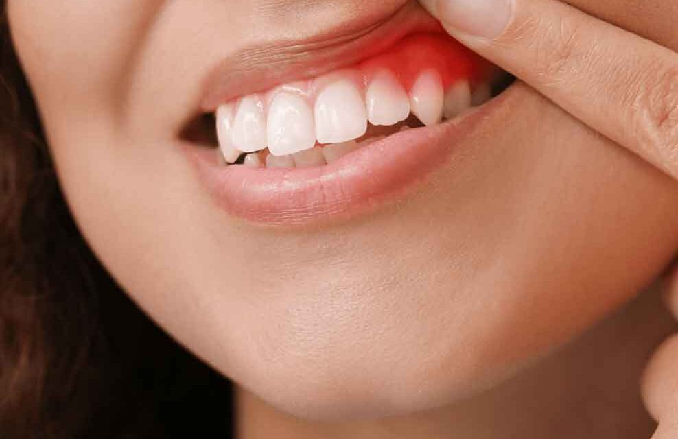 Diş Eti Hastalıkları Belirtileri Nelerdir ?