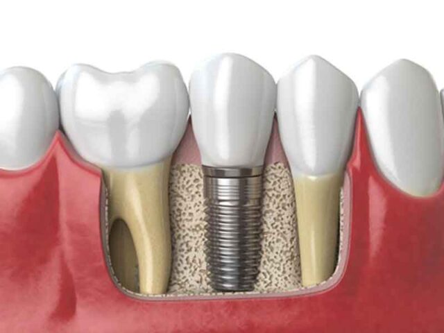 konya implant fiyatları, diş kliniği, dentium, implant tedavisi 