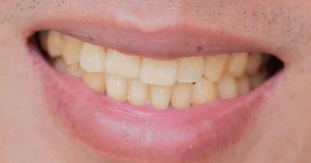 Diş sararması, diş sararması nedenleri, konya diş beyazlatma