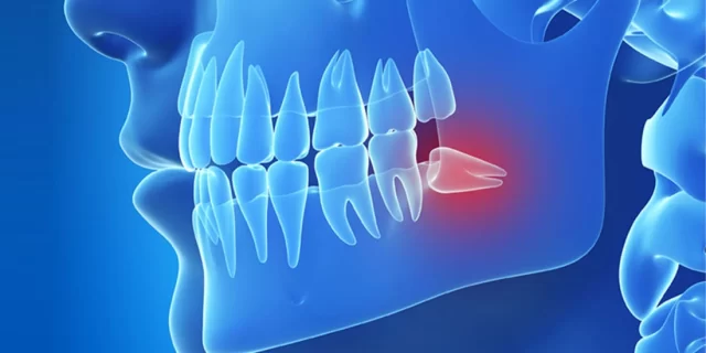 Gömülü Dişlerin Oluşumu: Nedenleri Ve Süreci