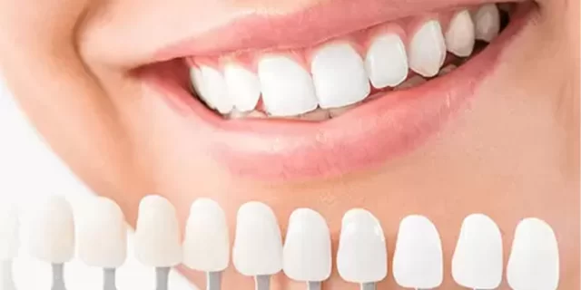 Diş Laminasyonu: Estetik Bir Gülümseme İçin İdeal Çözüm