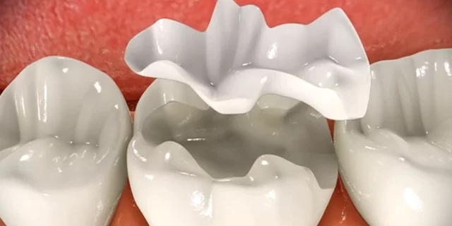 Onlay Dolgu: Diş Restorasyonunda İleri Bir Yöntem