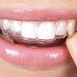 Şeffaf Diş Plağı Tedavi Süreci: Estetik ve Konforun Teknolojiyle Buluşması